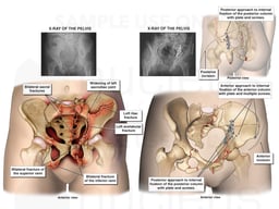 Pelvic Injuries and Surgeries