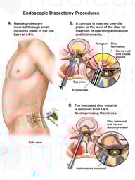 Lumbar Spine Surgeries