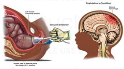 Birth Trauma - Vacuum Extractor Delivery with Head Injury