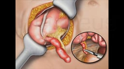 Open vs Laparoscopic Appendectomy