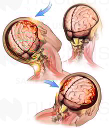 Coup-Contrecoup Brain Injury