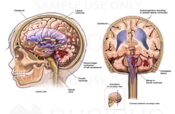 Traumatic Head Injuries