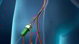 Coronary Angioplasty (Femoral Approach)
