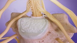 Peripheral Neuropathy