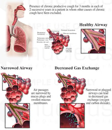 Chronic Bronchitis