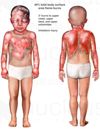 Front and Back Male Child Figures with Post-accident Burn Injuries