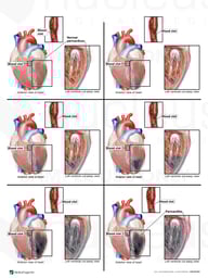 Progression of Ventricular Necrosis