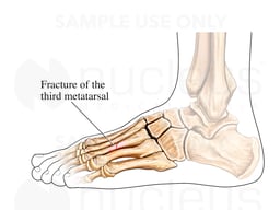 Stress Fracture of Left Third Metatarsal