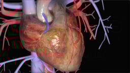 What is a Coronary Artery Bypass Graft (CABG)? 