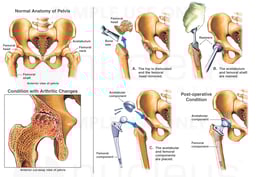 Total Hip Replacement Surgery