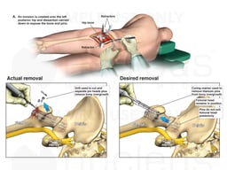 Actual vs. Desired Removal of Titanium Pins