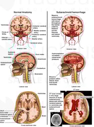 Subarachnoid Hemorrhage