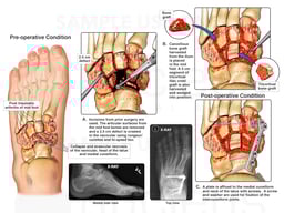 Left Mid Foot Arthrodesis