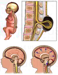 Congenital Birth Defects - Spina Bifida, Hydrocephalus and Arnold-Chiari Malformation