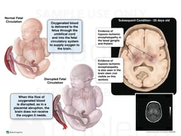 Ischemic Brain Damage
