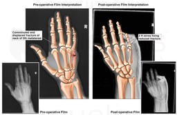 Right Hand Fracture with Percutaneous Fixation