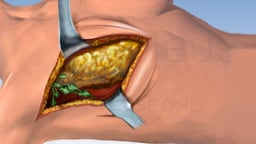 Breast Cancer Surgeries - Mastectomy