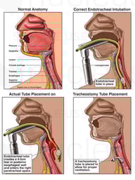 Surgical Intubation with Throat Damage