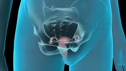 Tubal Ligation