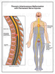 Thoracic Arteriovenous Malformation with Permanent Nerve Damage