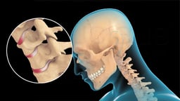 Hyperflexion of the Neck