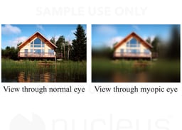 View Through Normal vs View Through Nearsighted Eye
