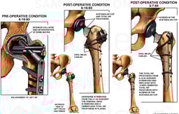 Avascular Necrosis of the Left Femoral Head with Surgeries