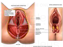 Third Degree Episiotomy Tear