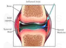 Steroid Injection in an Inflamed Joint