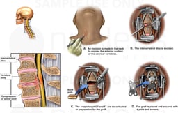 C7-T1 Spine Injury with Surgical Fusion