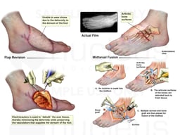 Left Foot Flap Revision and Tarsal Metatarsal Fusion of the Left Foot