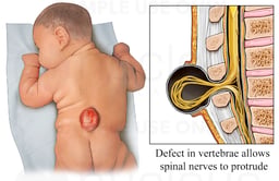 Spina Bifida