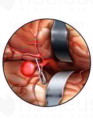 Clamped Aneurysm of the Cerebral Artery