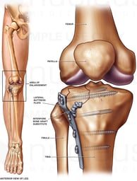 Post-operative Condition of Tibial Plateau Fracture