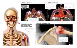 to the Mid Face, Orbits, Nasal and Shoulder Regions