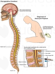 Testing for Cerebral Hemorrhage