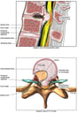 Failure to Repair Rupture of T11-12 Disc and Severe Spinal Cord Compression