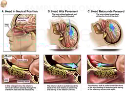 Shear Injury to the Olfactory Nerves (Cranial Nerve I)