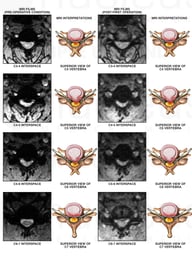 Cervical Disc Herniations with Impingement of the Spinal Canal
