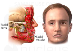 Bell's Palsy: facial droop