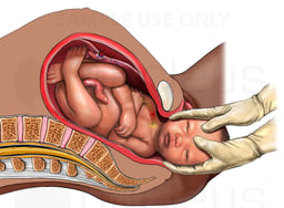 Vaginal Delivery with Brachial Plexus Nerve Injury (Shoulder Dystocia)