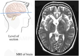 Brain MRI