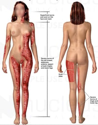 Severe Burn Injuries with Multiple Graft Harvest Sites