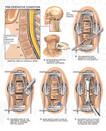 C3-4, C5-6 and C6-7 Disc Herniations with Multi-level Discectomies