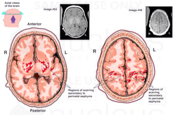 Radiological Evidence of Brain Injury from Perinatal Asphyxia