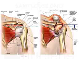 Normal Left Shoulder Anatomy vs Shoulder with Chronic Rotator Cuff Tear and Humeral Head Escape Syndrome
