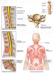 Multilevel Post-accident Neck and Back Injuries with Pain Diagram