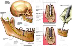 Inferior Alveolar Nerve Injury from Dental Drill