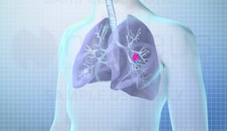 Screening for Lung Cancer