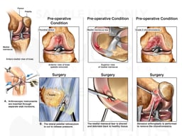 Surgical Procedures on the Left Knee